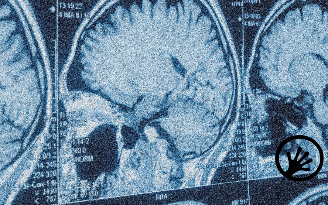 Discovering biomarkers in cerebrospinal fluid EVs