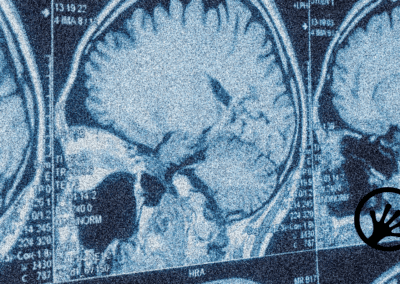 Discovering biomarkers in cerebrospinal fluid EVs