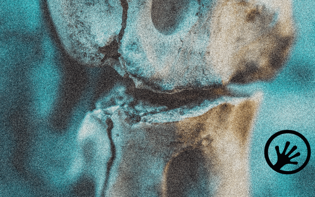 Gene expression biomarkers in osteoarthritis